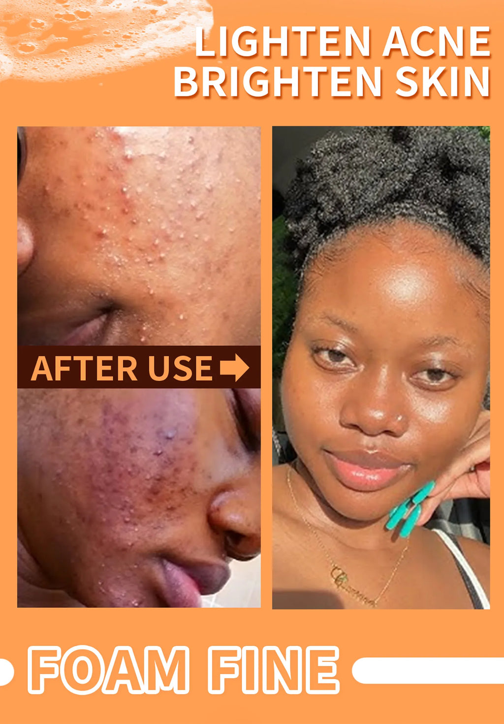 Barre de savon au curcuma biologique LKIAE, savon blanchissant à la main à base de plantes naturelles, réduit la mélanine, les boutons, l’acné, pour le visage et le corps, 200g