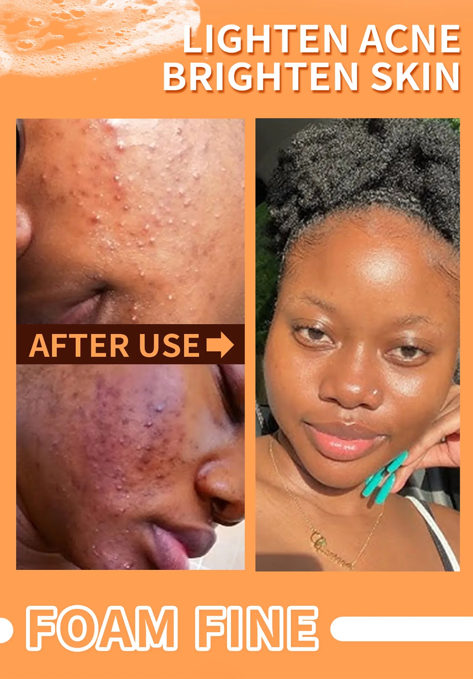 Barre de savon au curcuma biologique LKIAE, savon blanchissant à la main à base de plantes naturelles, réduit la mélanine, les boutons, l’acné, pour le visage et le corps, 200g