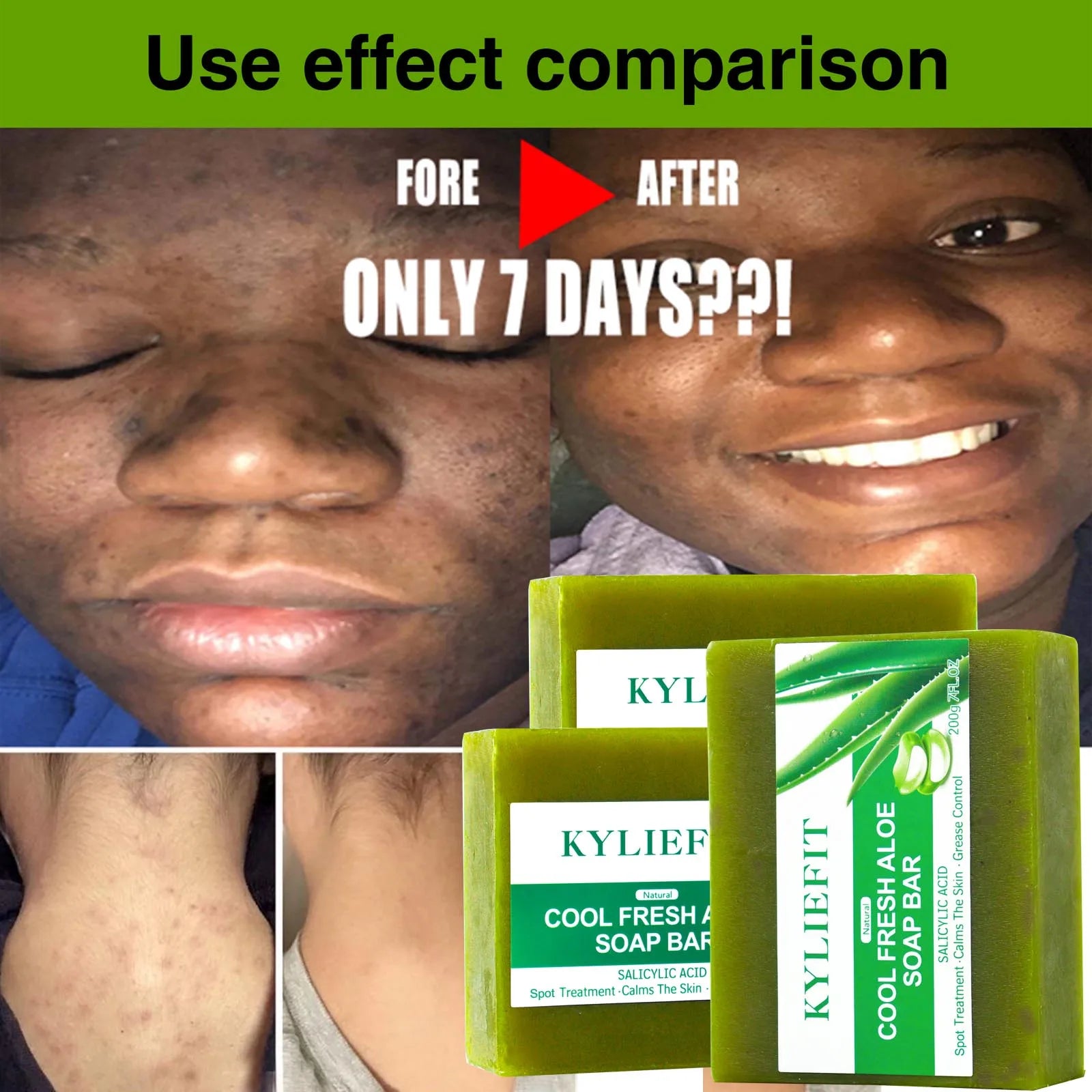 AILKE-Crème blanchissante pour tous les types de peau, efface l'acné, les boutons et l'éclat de la peau