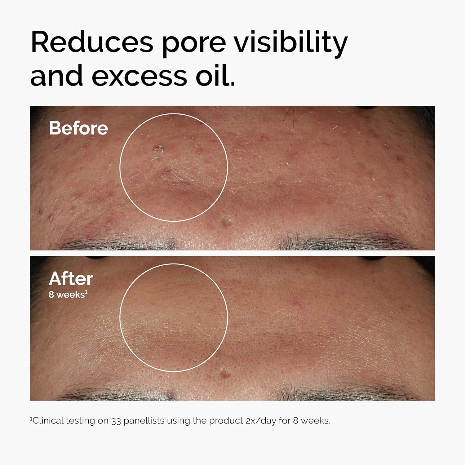 30 ml de 10% Niacinamide+1% zinc, adapté au sérum lisse sur la peau propriétaire aux problèmes, adapté aux hommes et aux femmes