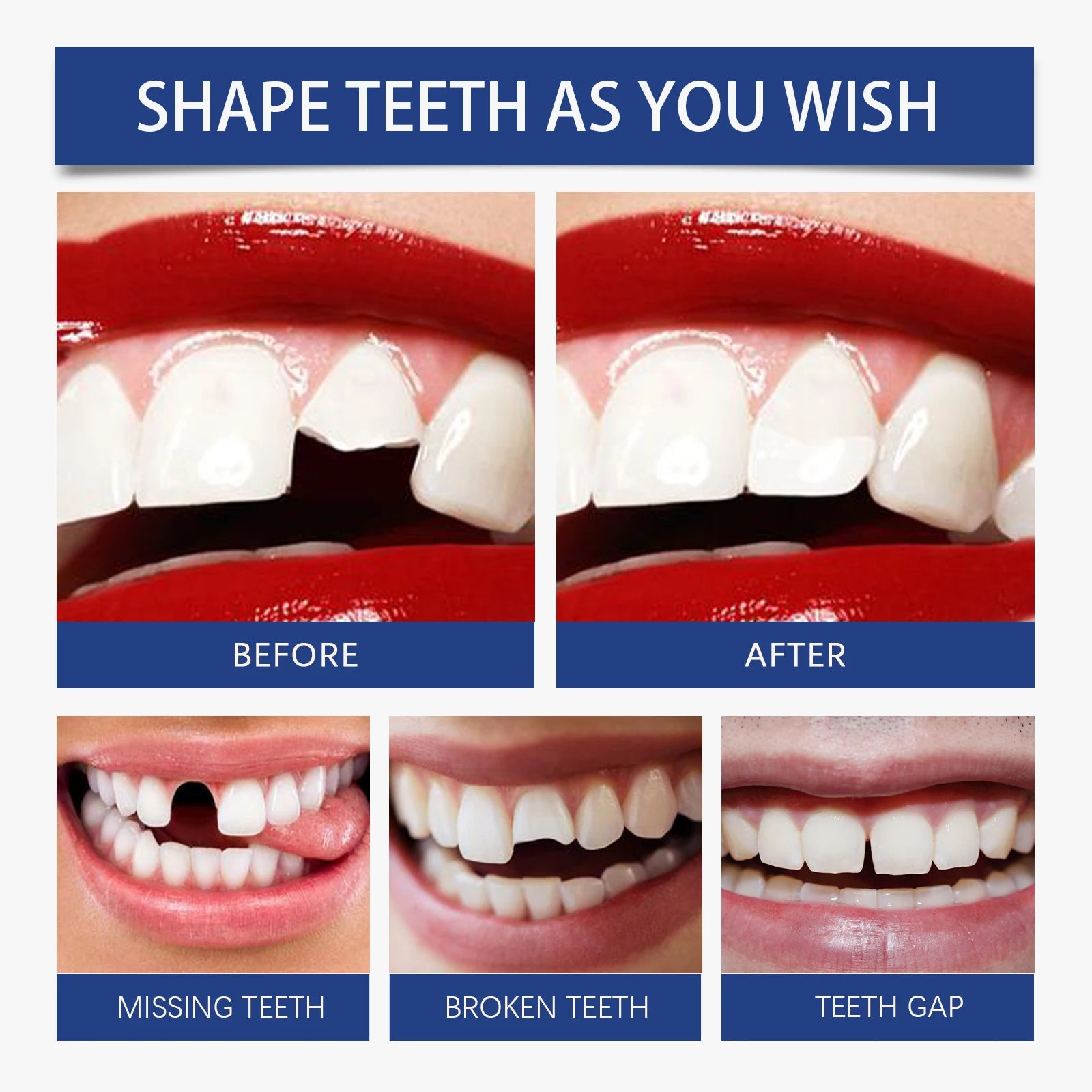 Colle Dentaire en Résine Solide 30ml - Réparation Temporaire des Dents et Comblement des Espaces